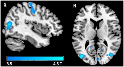 Proprioceptive and tactile processing in individuals with Friedreich ataxia: an fMRI study